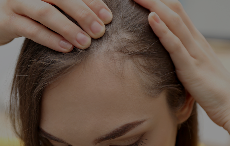 Traction Alopecia: The Hair Loss From Tight Hairstyles