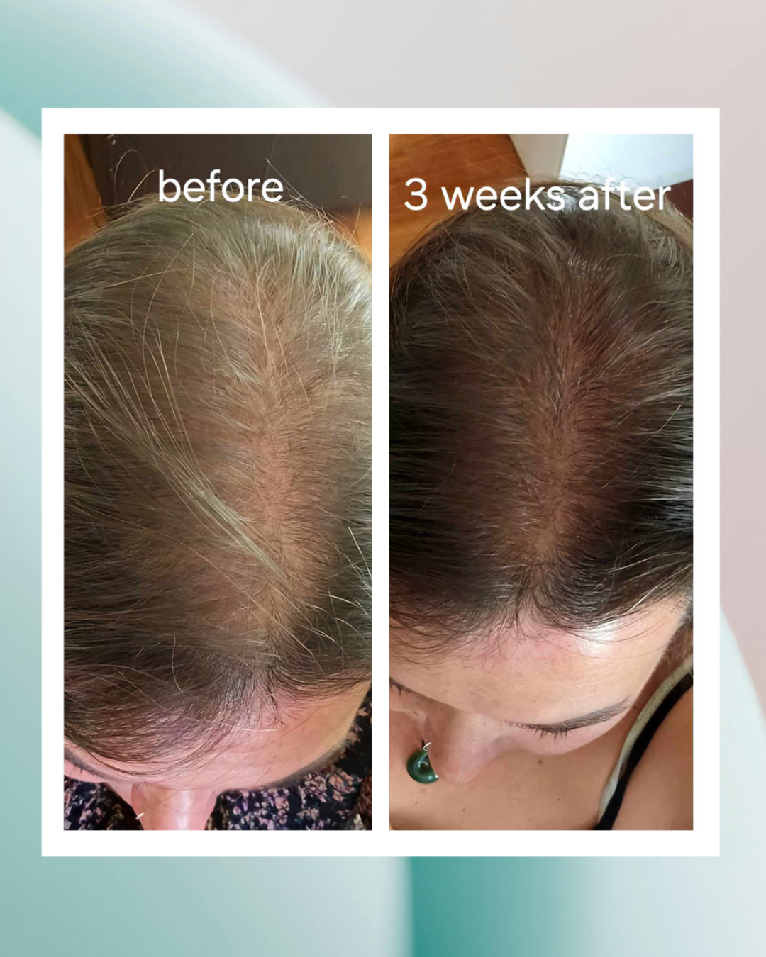 Before and after comparison of hair growth on a person's head.