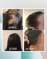 Before and after comparison of hair growth over a period of three months.