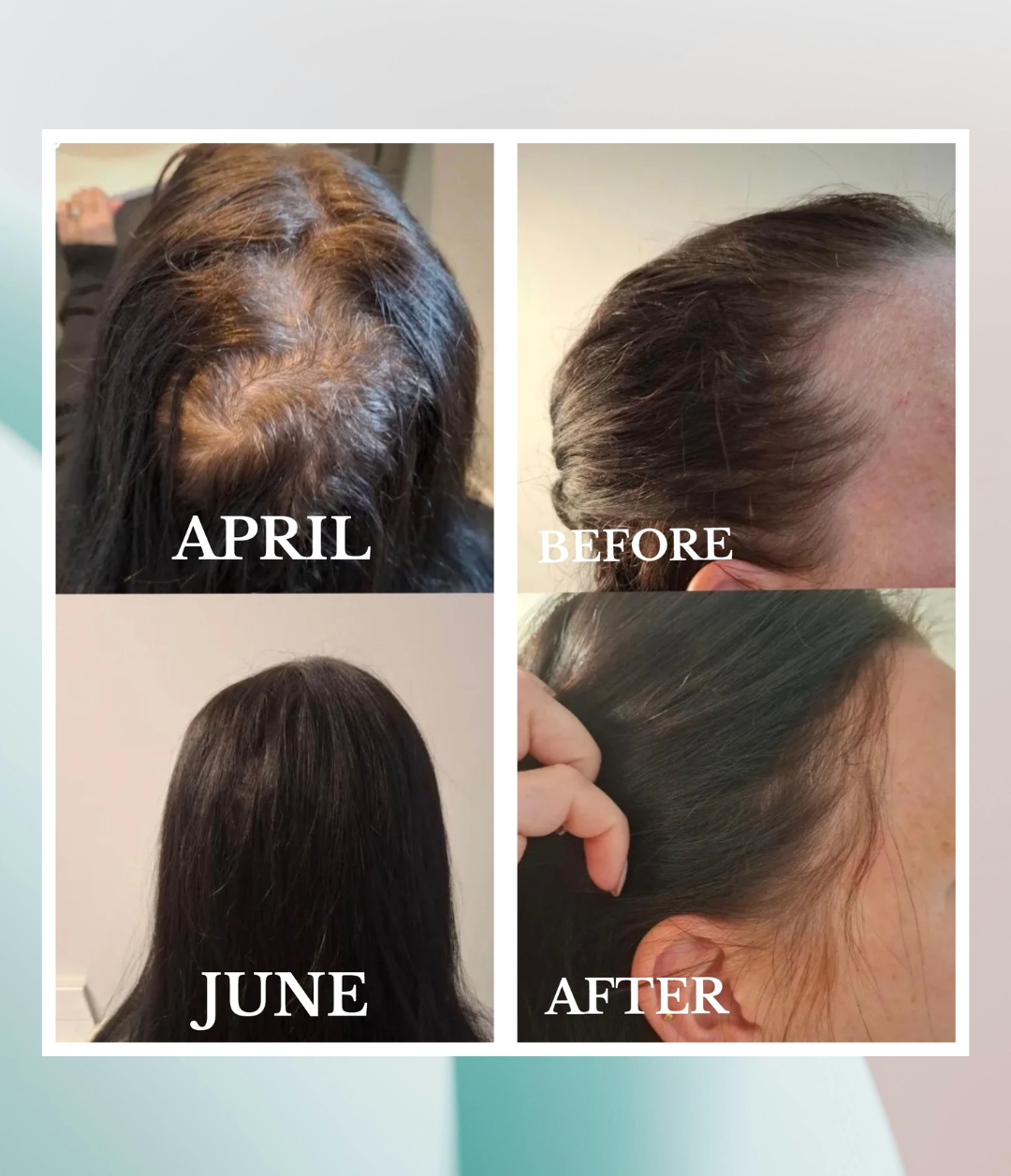 Before and after comparison of hair growth over a period of three months.